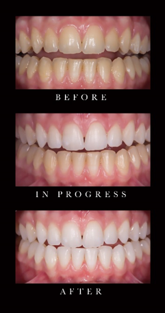 Teeth Comparison